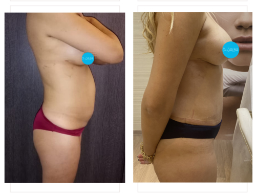 Tummy tuck