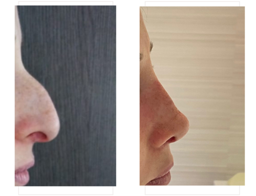 Rhinoplasty