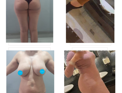 Breast lift, liposuctio, liposculpture & BBL