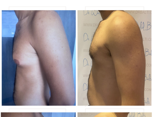 Gynecomastia surgery