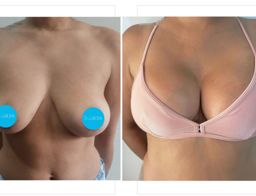 Breast lift with implants