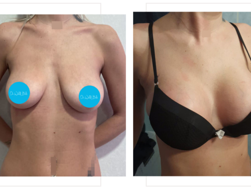 Breast lift with implants