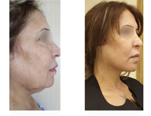Facelift, face fatgrafting, platysmaplasty and neck liposuction