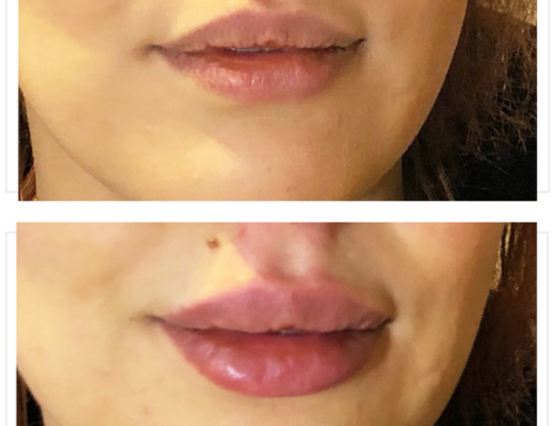 Lip augmentation