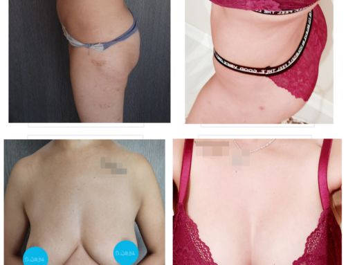 Breast augmentation, buttock augmentation & tummy liposuction