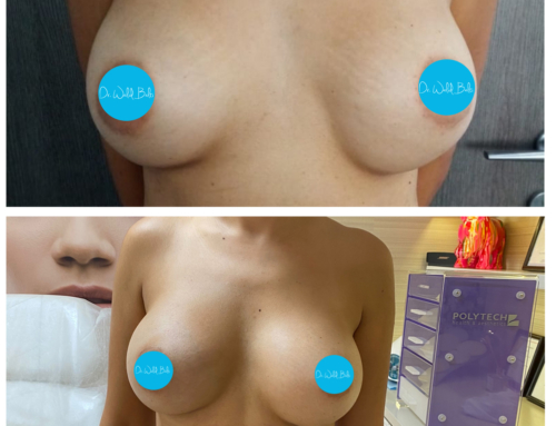 Breast revision surgery