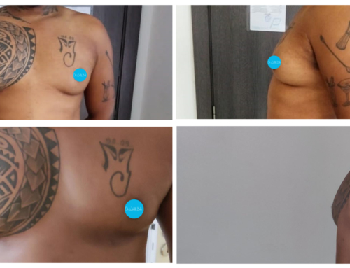 Gynecomastia surgery