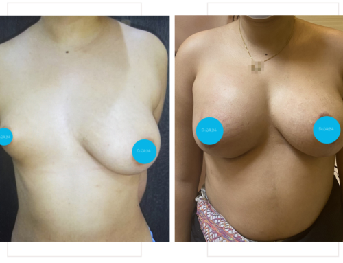 Correction of breast asymmetry with implants, lifting and fat injection
