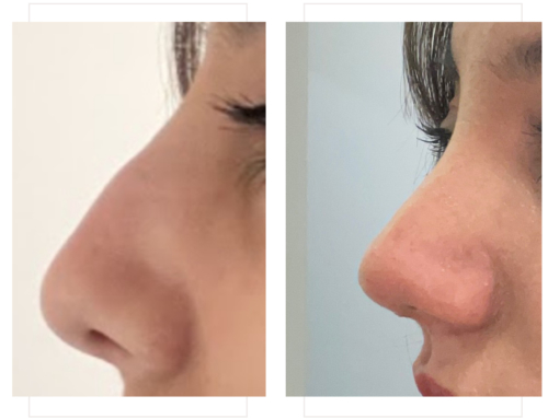 Rhinoplasty