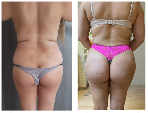 Liposculpture & BBL