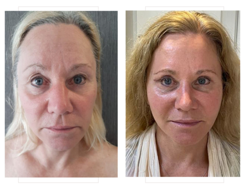 Facelift & upper blepharoplasty