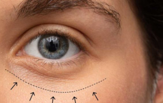 How blepharoplasty treats the lower and upper eyelids