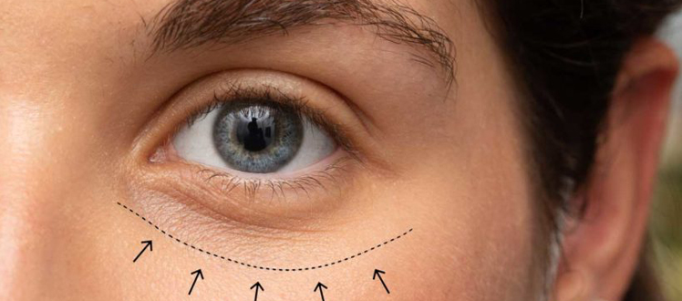 How blepharoplasty treats the lower and upper eyelids