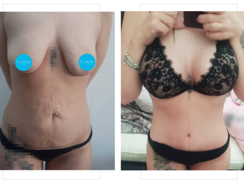 Breast lift with implants & tummy yuck