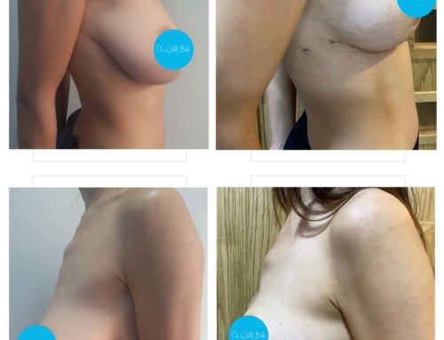 Breast lift without implants