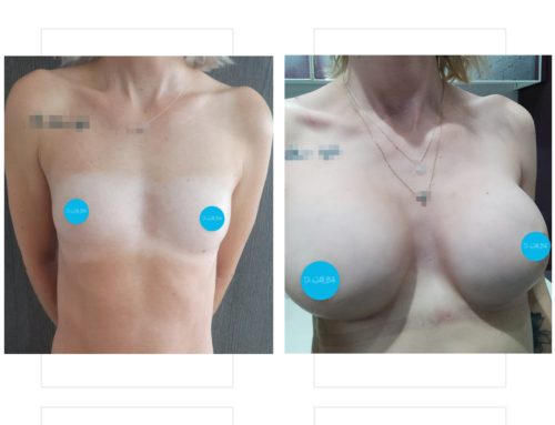 Breast augmentation