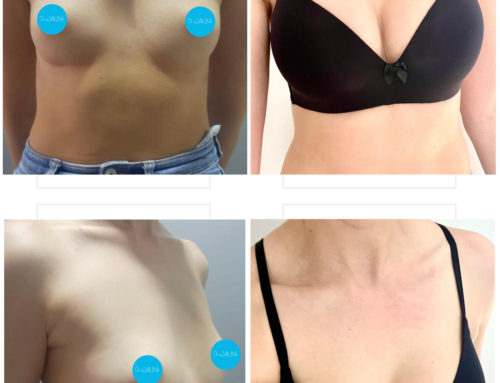 Breast augmentation