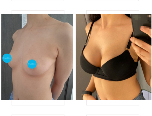 Breast augmentation