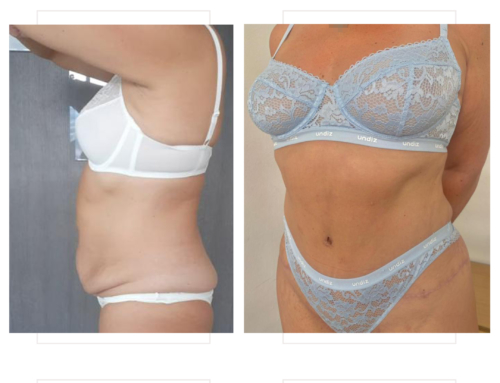 Tummy tuck