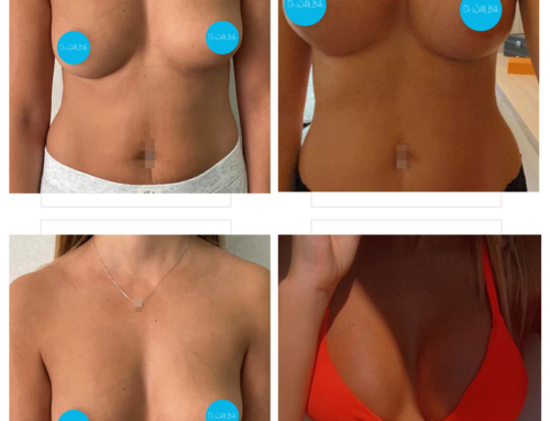 Breast augmentation