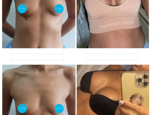 Breast augmentation