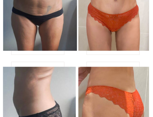 Liposuction & tummy tuck