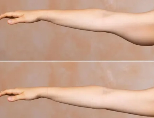 Arm lift incision patterns explained