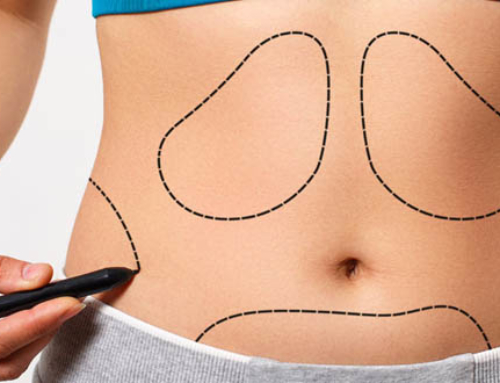 Liposculpture : what it is and what it does for men and women