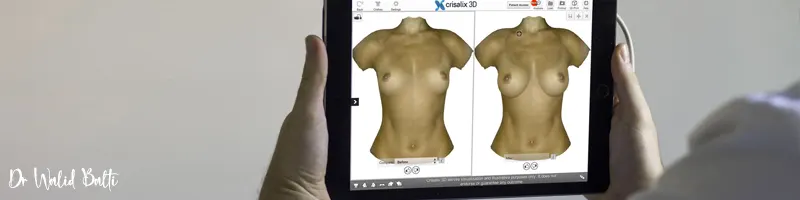 3D Crisalix simulation for breast augmentation tunisia